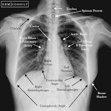 Chest X-Ray